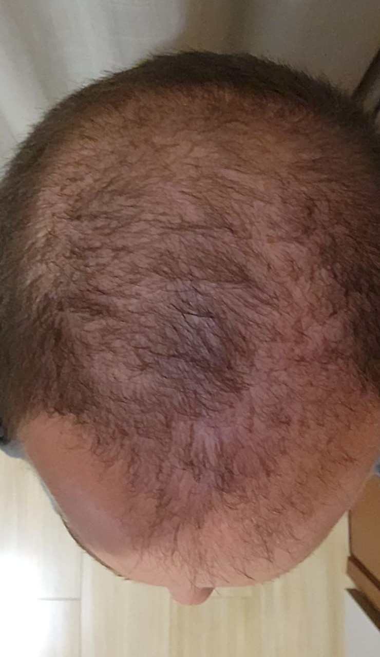 Depois do tratamento